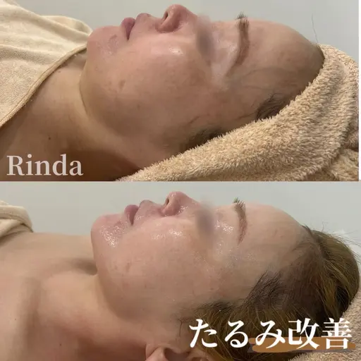 フェイスライン!フォースカッター(ラジオ波)フェイシャルで浮腫み/食いしばり/エラ改善/首肩デコルテまでスッキリ♪