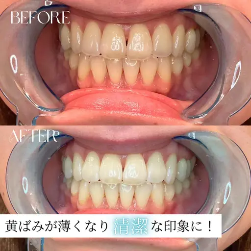 初回限定【セルフホワイトニング｜20分照射】お気軽お試し✨自然な歯の白さ/術後制限なし/着色予防　¥4500→¥2880