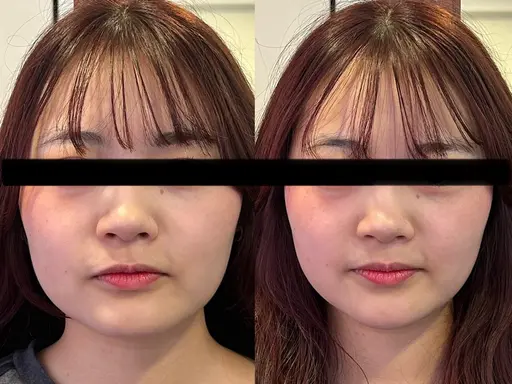 7月限定❗️口コミ投稿で体験価格🦴✨エラ張りやフェイスラインを整えます🌟Quick小顔矯正 (25分) ¥1,500