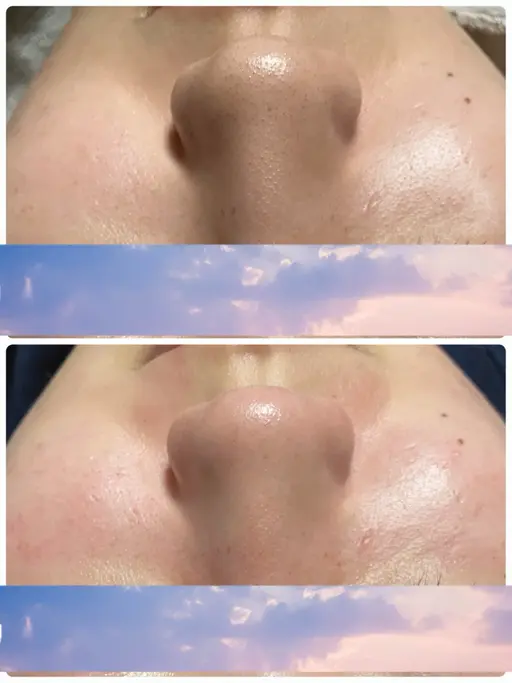 【毛穴ケアの悩みから解放♡】ポアリファインフェイシャル💎導入記念✨8000円→初回6800円✨