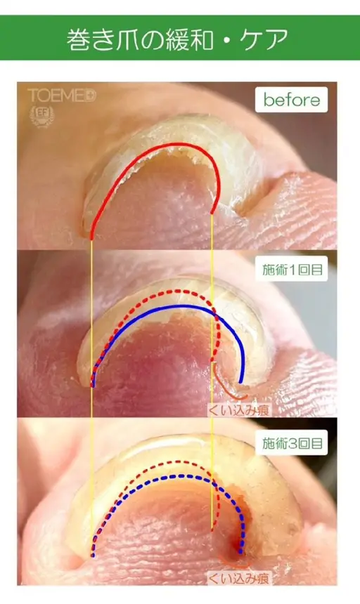 巻き爪ケアジェルモニター募集※下記注意事項を必ずご確認ください