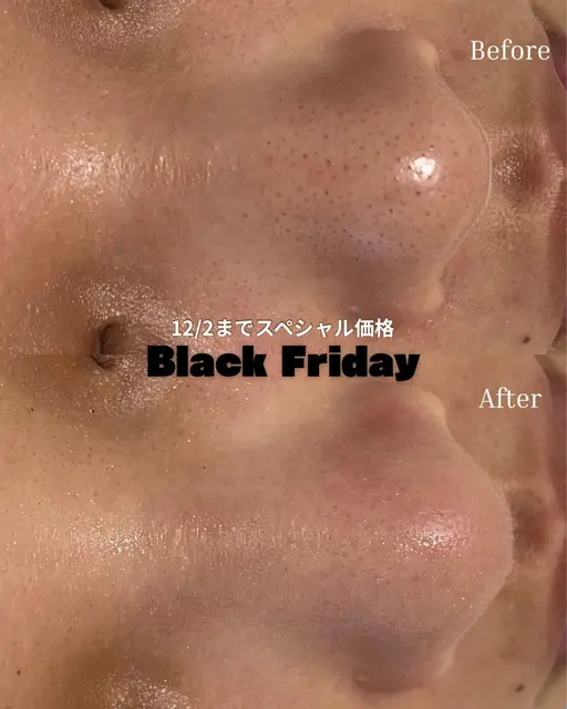 【ブラックフライデー限定】ハーブ×毛穴吸引￥12000