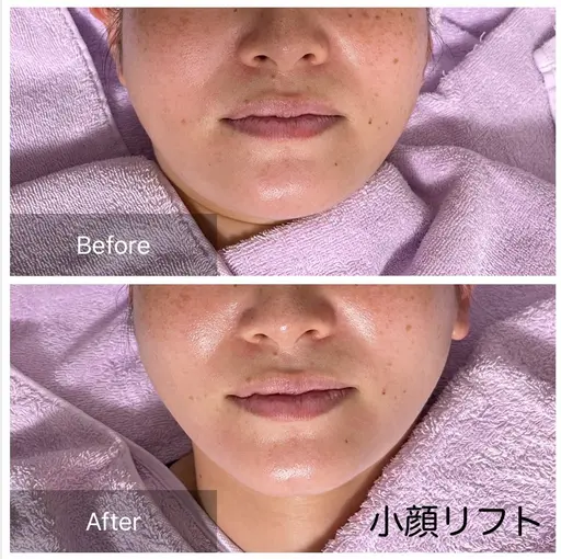 🌸1日1名様限定🌸小顔リフト+お肉取り