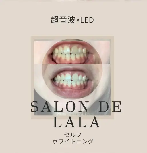 1回で違う超音波×LEDのセルフホワイトニング 15分×2回 固定タイプの為左右に動いても全体的にしっかりライトがあたる