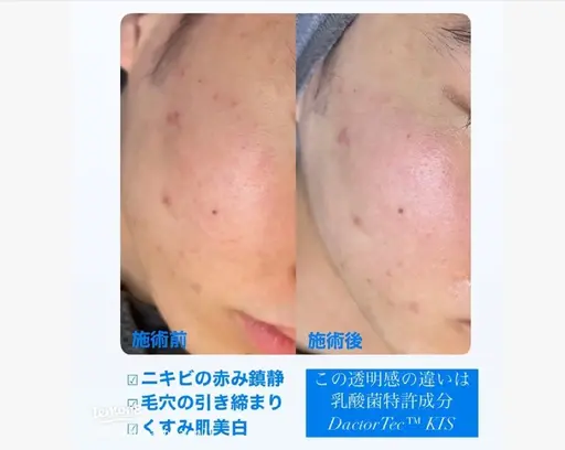 ハイドラフェイシャル+セラピール【水光肌】30代以降のお肌にハリとツヤ!ニキビ、美肌ケアにも✨️