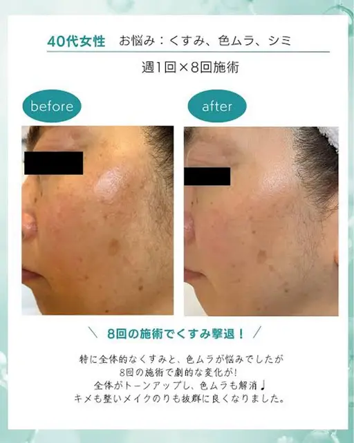 【フェイシャル人気Ｎｏ．1✨️】水光白玉フェイシャル 100分🫧