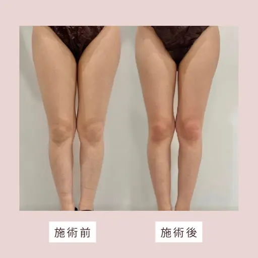 モニター価格🌸肩こり・むくみ改善✨インディバボディ90分✨️