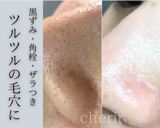 口コミ投稿必須🔥大幅値引き!【ハイドラ毛穴洗浄】※オプションメニュー追加不可