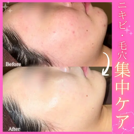 【話題の最先端ニキビケア❤️‍🔥】毛穴詰まり×肌荒れをトリートメントケア✨透明感あふれるつるん素肌をサポート ׅ ⊹