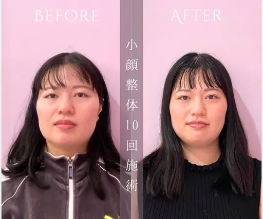 【モニター募集】長年の食いしばりによるエラ張りの方/BeforeAfter撮影OKな方限定📸