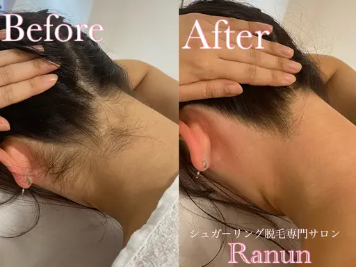 【うなじ+背中Wピーリングケア💎美肌特化】後ろ姿を整えて垢抜け美人オーラ《今だけ1万円OFF》