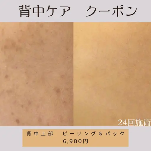 背中（上部）ニキビケアピーリング🪿本気の背中肌改善🔥