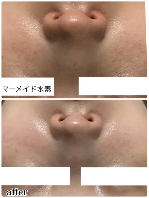 【ハリ✨キメ✨ツヤ✨水光肌】マーメイド水素トリートメント🧜‍♀️🫧