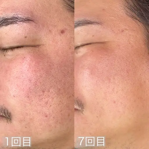 【プラズマニア】シミだけじゃない！クレーター肌や毛穴に効果絶大な最先端美容25000円→18000円