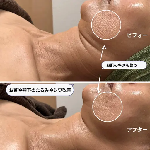 シワたるみ改善コース ◎イチオシ✨30代からのエイジングケア✨【ヘッドスパ付ヒト幹×炭酸×リフトアップマッサージ】
