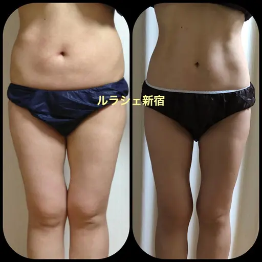 痩せ効果NO.1🥇【スペシャル】筋膜リリースインド+高周波+腸マッサージ+足つぼリフレ🔥大量発汗🔥120分