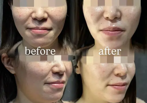 【1日2名限定】肌管理モニター🫧毛穴・ニキビ・赤み・ザラつき改善／フェイシャル歴6年以上のベテランスタッフ施術✨