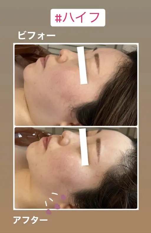 💆‍♀️最強リフトアップをモニター価格で💎小顔効果メスいらず💆‍♀️4000shot！美容鍼以上の効果！