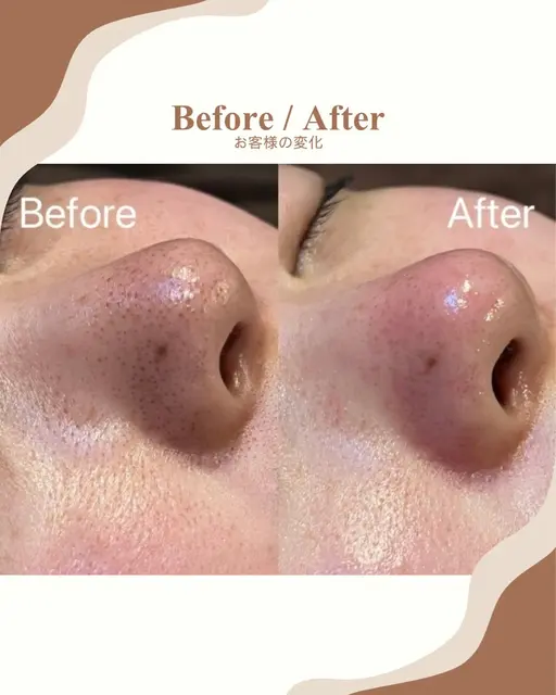 【11月限定価格】毛穴洗浄ハイドラフェイシャル《ビタミン導入付き》