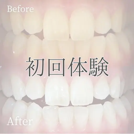 【ミニモ限定】初回体験✨40分¥2500ホワイトニングデビューは当店におまかせ✨口コミ必須🫶