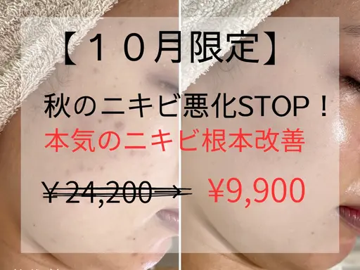 【10月先着5名】秋のニキビ悪化STOP！天然微細針でニキビ根本ケア¥24200→¥9,900