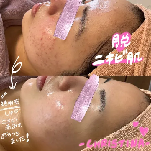 8/18～8/25期間限定割引🌈肌荒れ赤み改善・水光肌育成ピーリング🩵お肌に合わせてオーダーメイドフェイシャル🫧