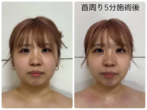 【✨1番オススメのクーポン✨】肩周り集中ケア○全てのケアはここから○顔周りがスッキリメニュー○