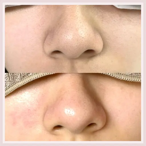 オールハンドの毛穴の黒ずみケア 👑0円モデルは今月が最後です‼️補足を必ず読んでください。