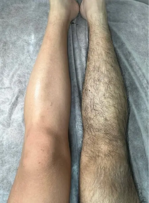 🌟男性🌟【魅せる脚.腕】両足両腕ブラジリアンワックス脱毛