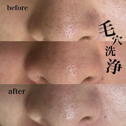 【毛穴黒ずみ撃退💥】韓国式美肌毛穴洗浄 -全顔-