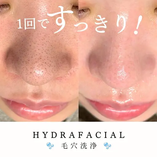 🫧HYDRAFACIAL🫧黒ずみ改善毛穴洗浄(全顔)¥8,300→6,500(メンズ+1000円)