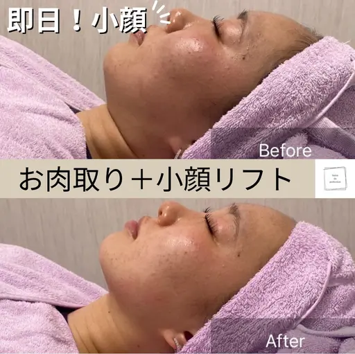 【✨1日1名様限定✨】たった１回でこの効果‼️最強小顔リフト5200shot＋お肉取り