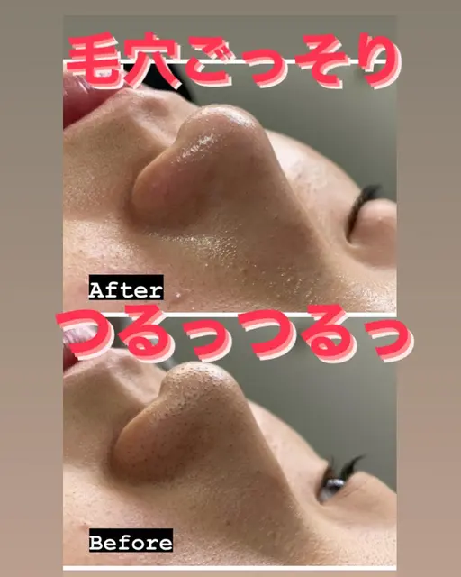 美肌の基本‼️全顔毛穴洗浄🌟定期的なお肌のお掃除をしましょう😌それだけで、美肌になれます！これは本当です‼️