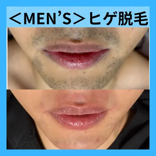 【メンズ脱毛大人気No1】ヒゲ脱毛　朝3分のヒゲ剃り、無くしませんか？
