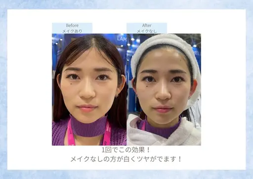⭐土日限定⭐【白玉ピーリング】白雪肌を目指す最強美白ケア✨シミ、毛穴、たるみ、しわをダウンタイムゼロで改善❕