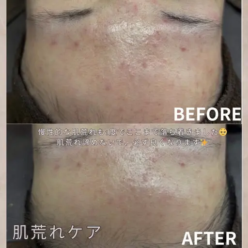 【ニキビ肌から艶肌に✨】お試しダウンタイム痛みなし✖️ニキビ跡や軽度のクレーターにも◎幹細胞ハーブピーリング🌿90分