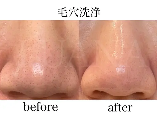 気になる黒ずみ毛穴に✨毛穴洗浄+韓国肌管理