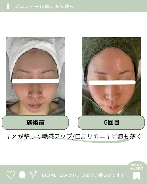 🪸肌質改善ピーリング🪸HAAB REPRO|初回体験 施術のみ