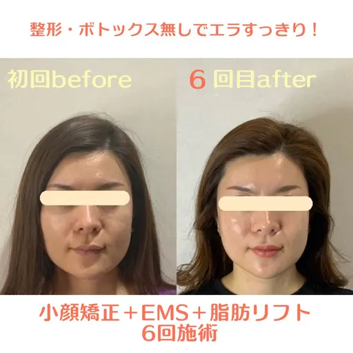 劇的小顔リフト(小顔矯正+ems+超音波)💆♀️丸顔/エラ/二重顎/フェイシャルマッサージ/小顔マッサージ/コルギ