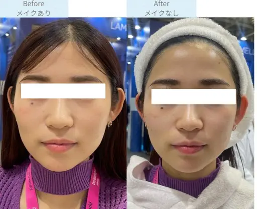 新メニュー💖最強美白ケア❗️悩みの種に即アプローチ❗️揺るがない肌作り実現✨くすみ、シミ、毛穴、たるみにも◎