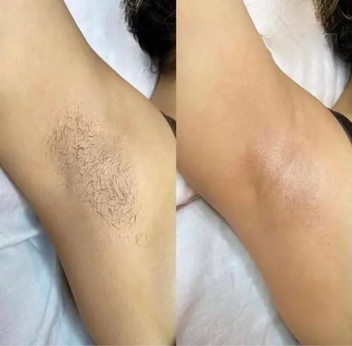脇wax脱毛