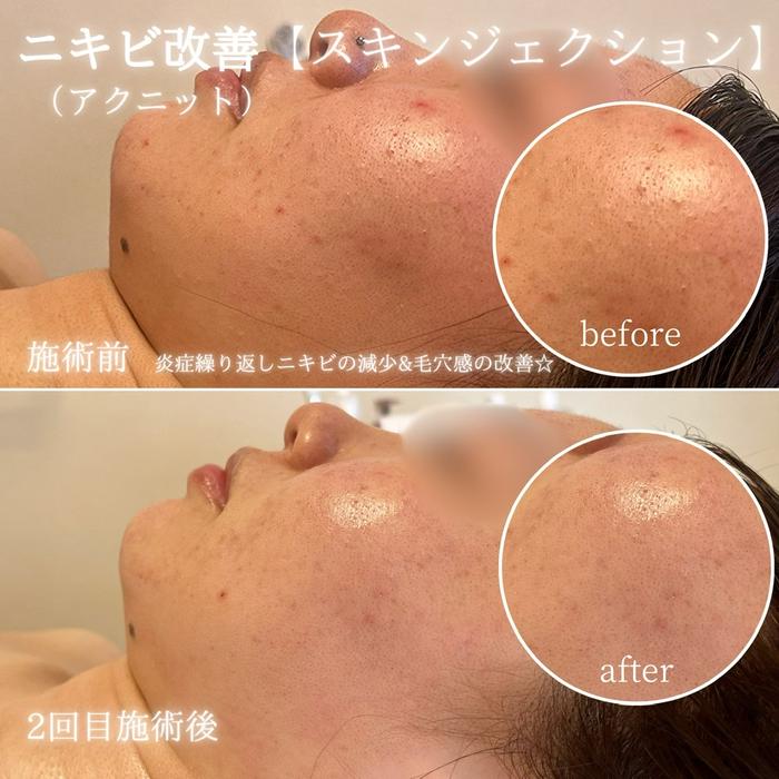 エステ・リラクフォトカタログ「ニキビ改善には最先端韓国肌管理の