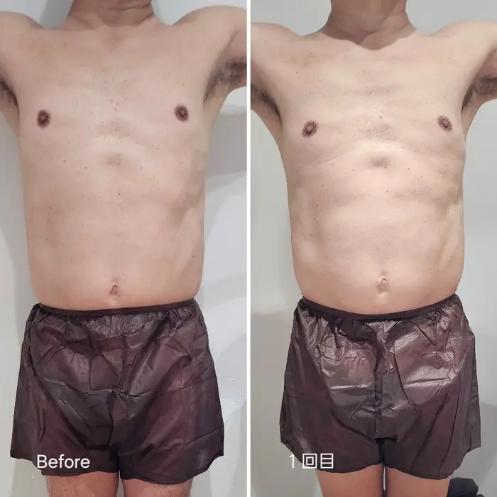 美容サロンカタログカタログ「上下腹部2カップの Before→Afterのお写