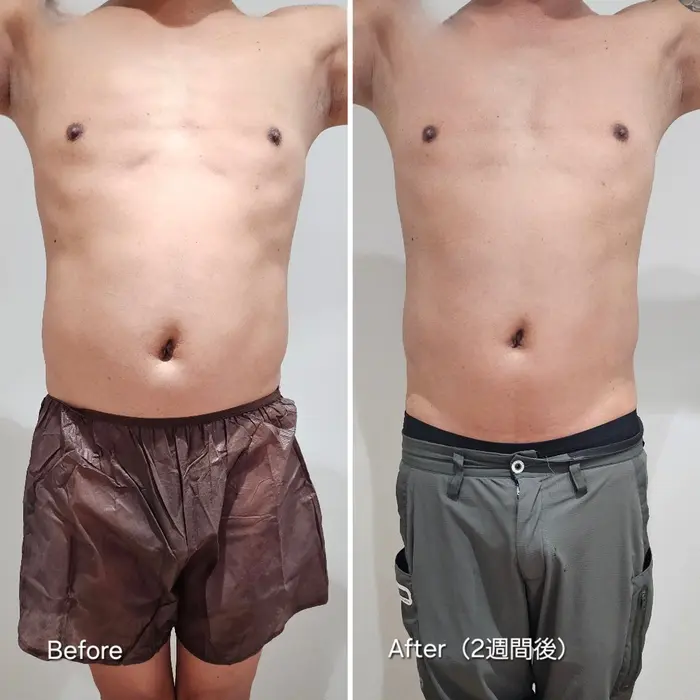 美容サロンカタログカタログ「上下腹部2カップの Before→Afterのお写