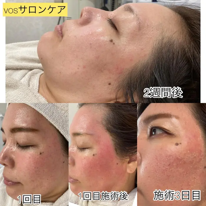 VOS サロンケア 業務用 3回分 vos サロンケア 1回分 VOS サロンケア