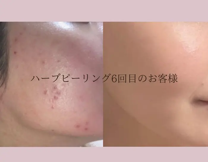 エステ・リラクフォトカタログ「剥離ありハーブピーリング6回目の