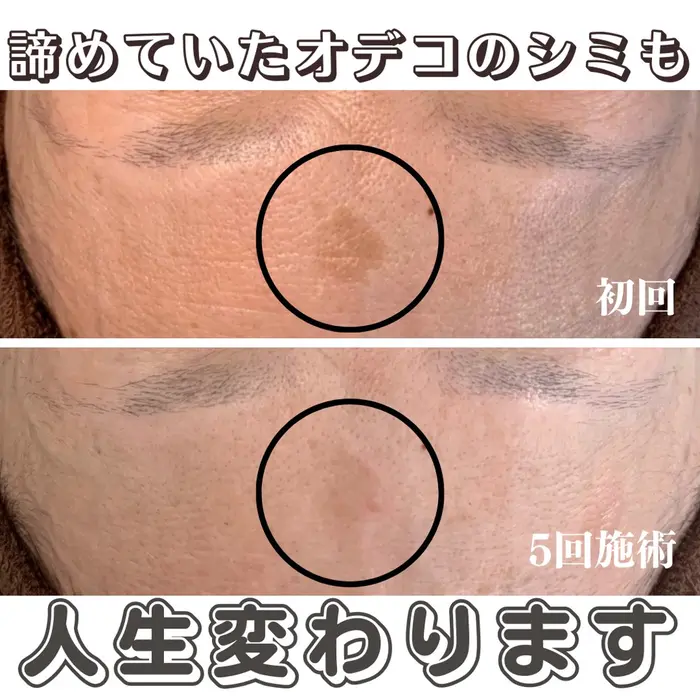 エステ・リラクフォトカタログ「当サロンのシミケア機器は低周波で行う
