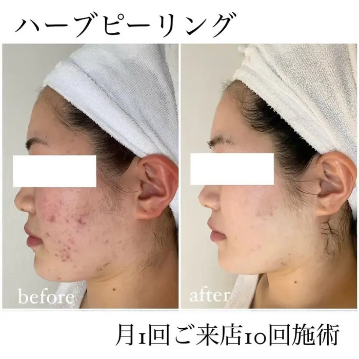 ハーブピーリング　3回分 ハーブピーリング3回の効果 | ニキビ 毛穴 ピーリング専門サロンCALIN