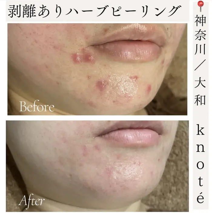 【12月31日まで年末セール】剥離ありハーブピーリング10回分 3937fd30e253946b0b05a615e9674c