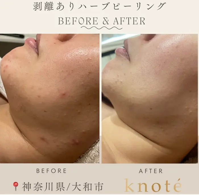 美容サロンカタログカタログ「ハーブピーリング剥離あり コース3回で